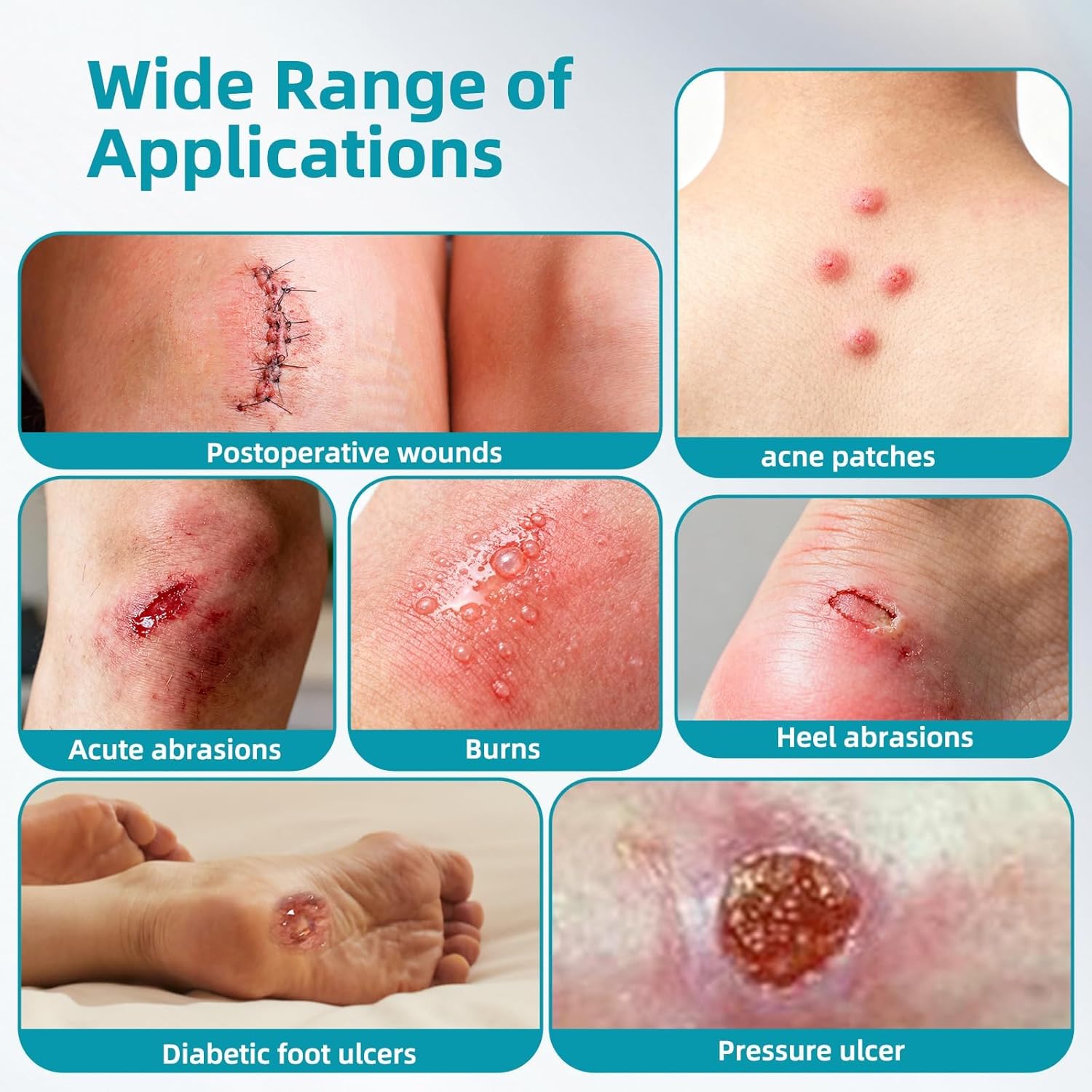 Medical-Grade Hydrocolloid Roll