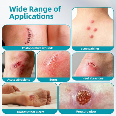 Medical-Grade Hydrocolloid Roll